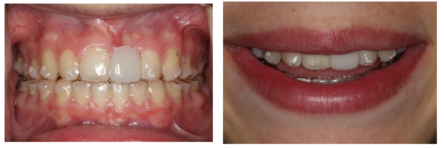 Isabelle Baillargeon orthodontiste, invisalign et dent manquante, facilitant