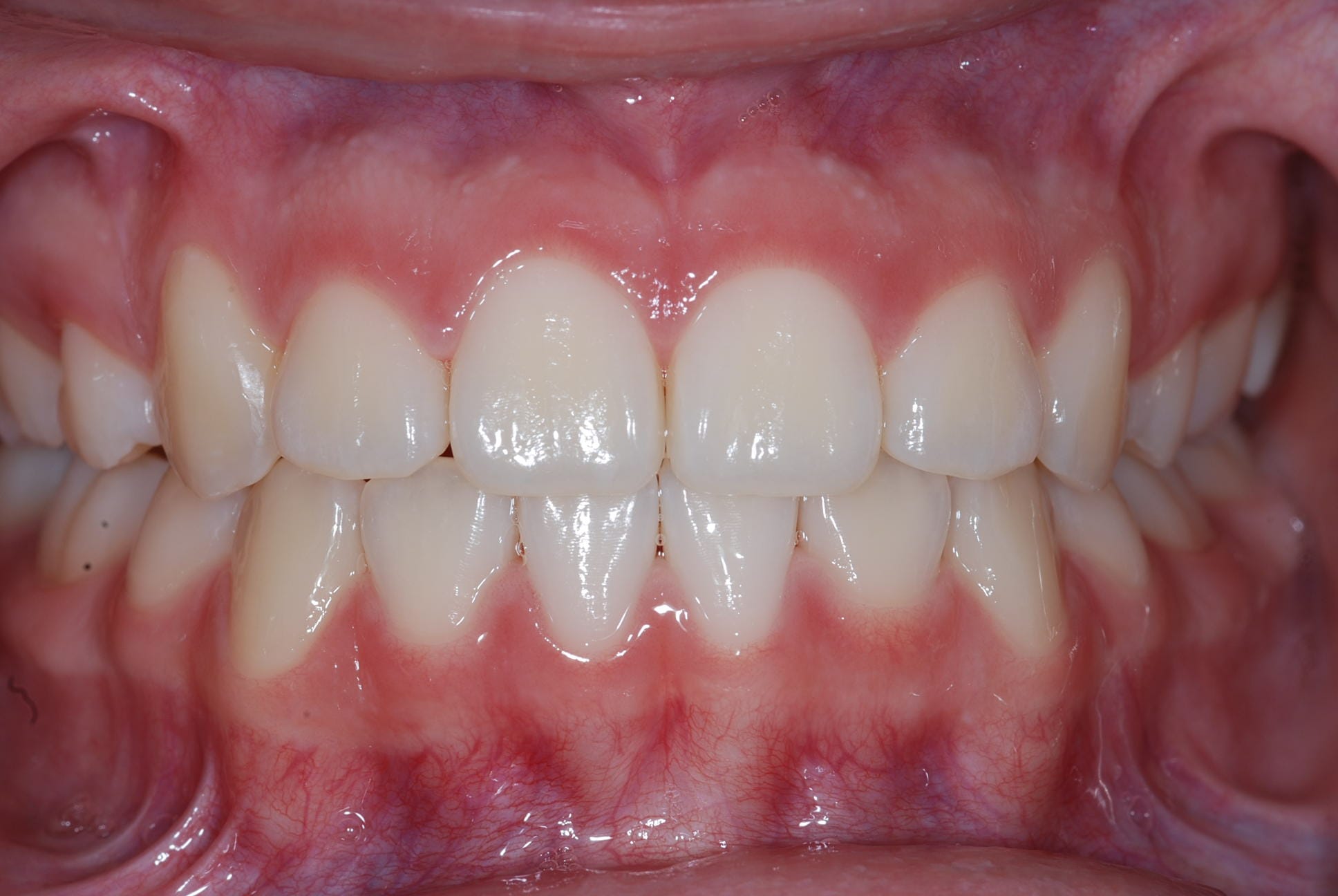 Isabelle Baillargeon orthodontiste résultat
