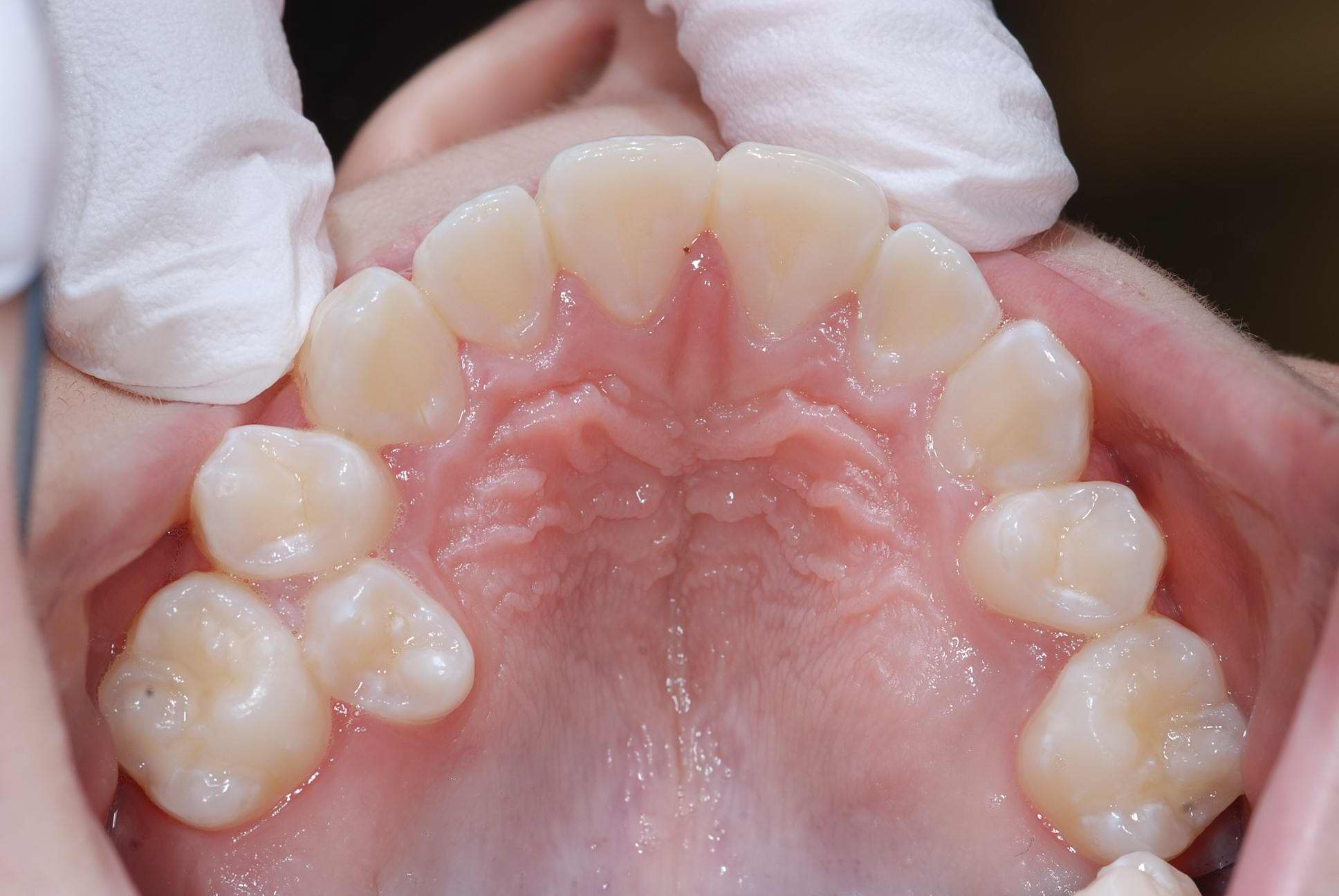 Isabelle Baillargeon orthodontiste Québec expansion palatine 2/4