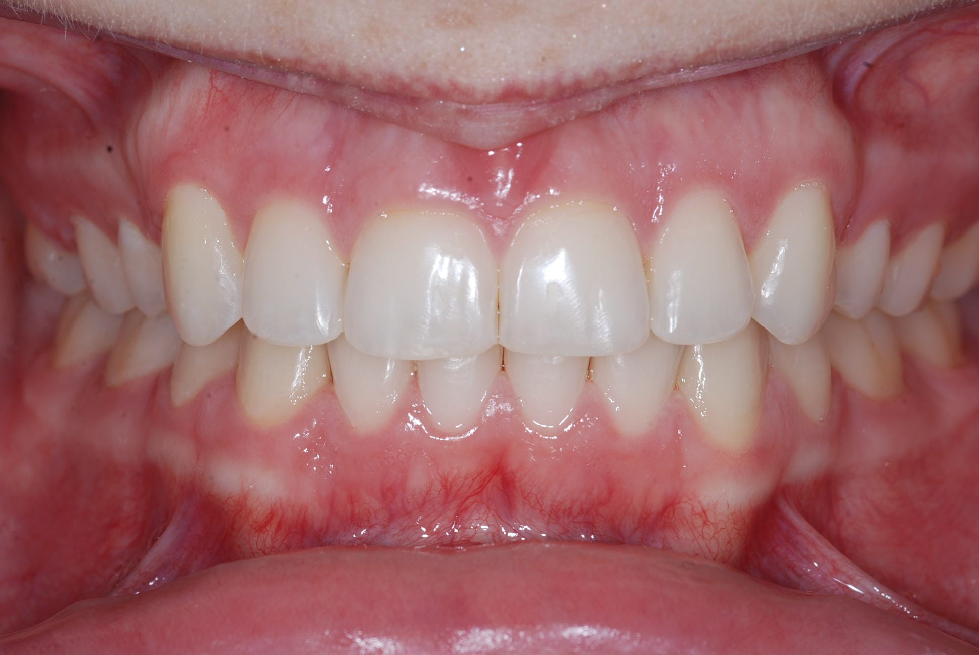 Isabelle Baillargeon orthodontiste résultat