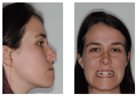 Isabelle Baillargeon orthodontiste Avant