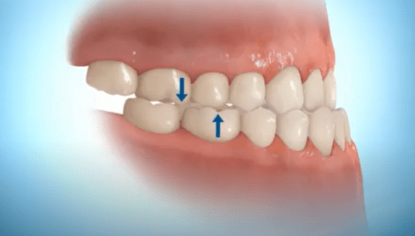 Malocclusion-de-classe-3 Dre Isabelle Baillargeon orthodontiste