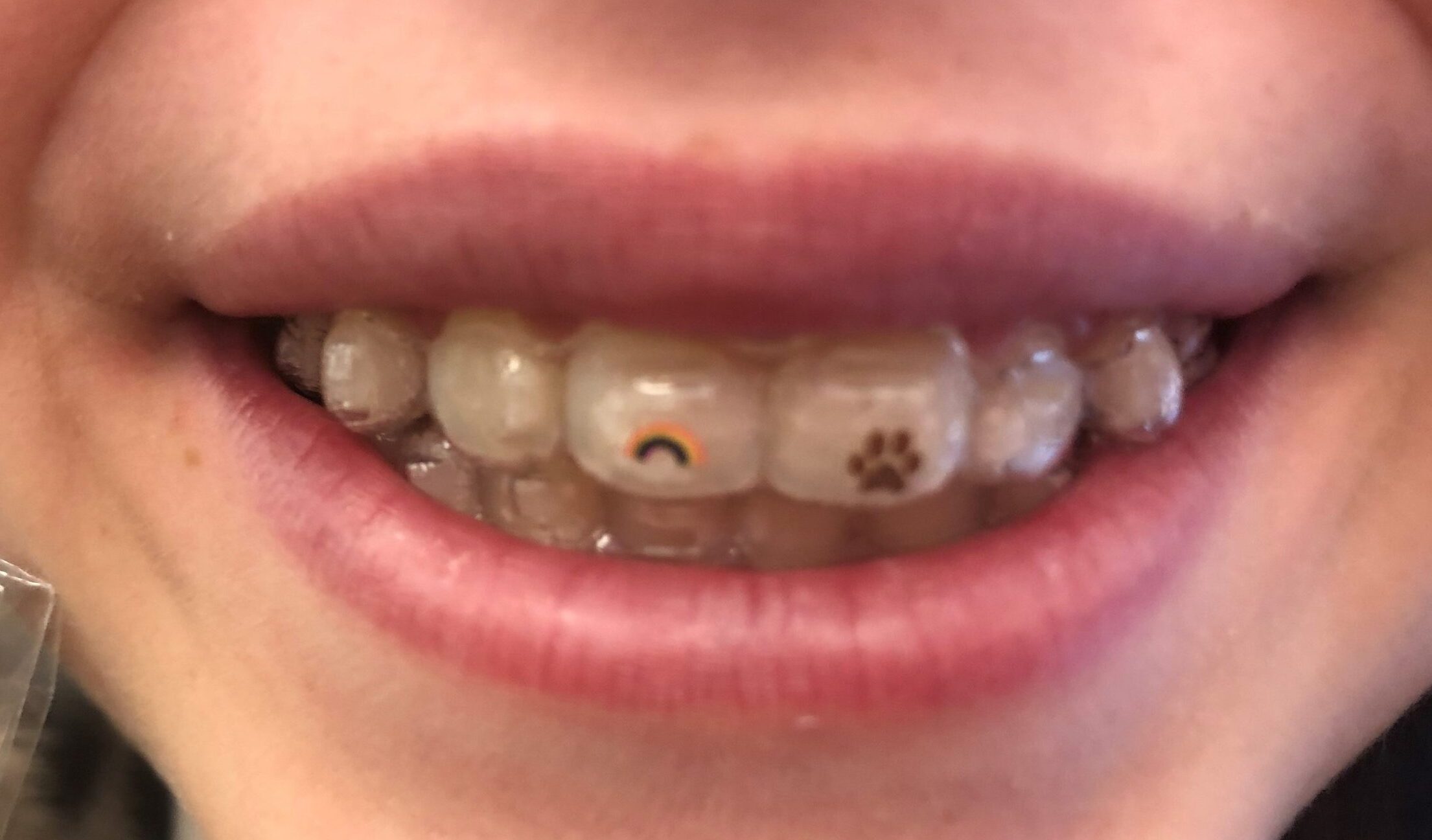 Photo, exemple autocollant Invisalign et Dre Baillargeon