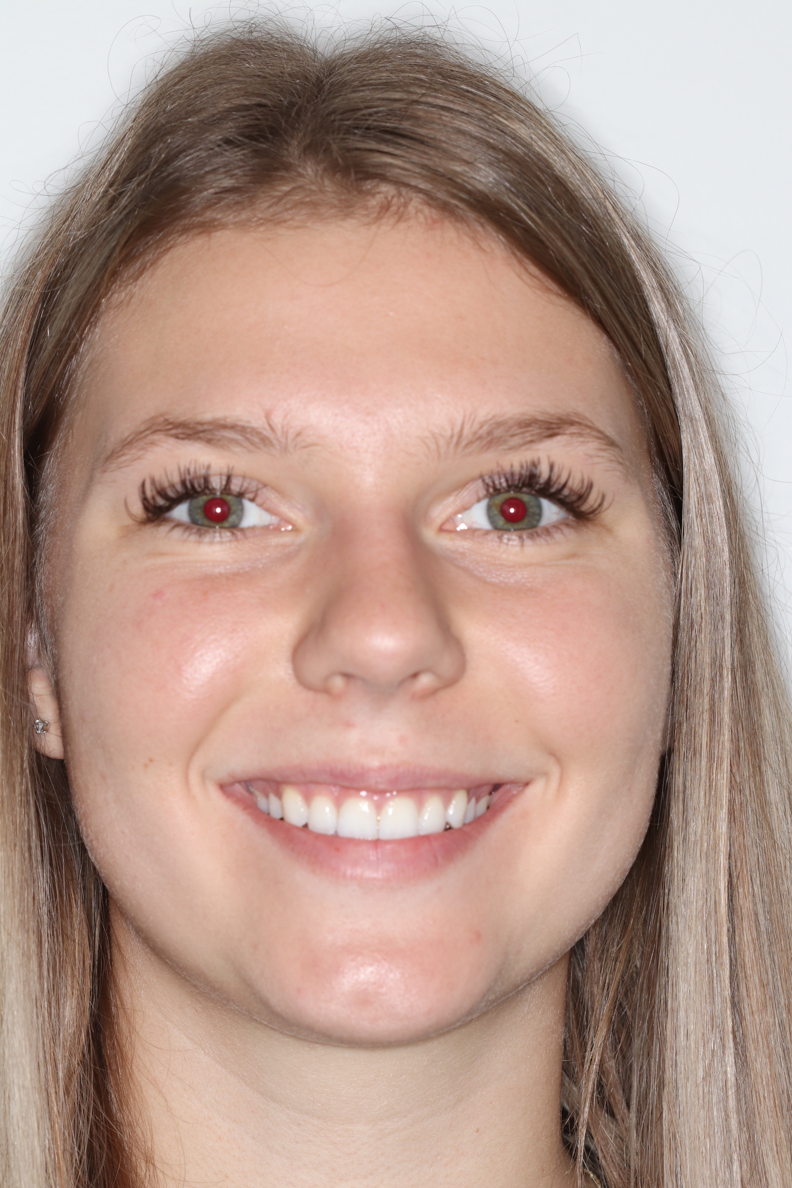 Génioplastie Dre Isabelle Baillargeon orthodontiste